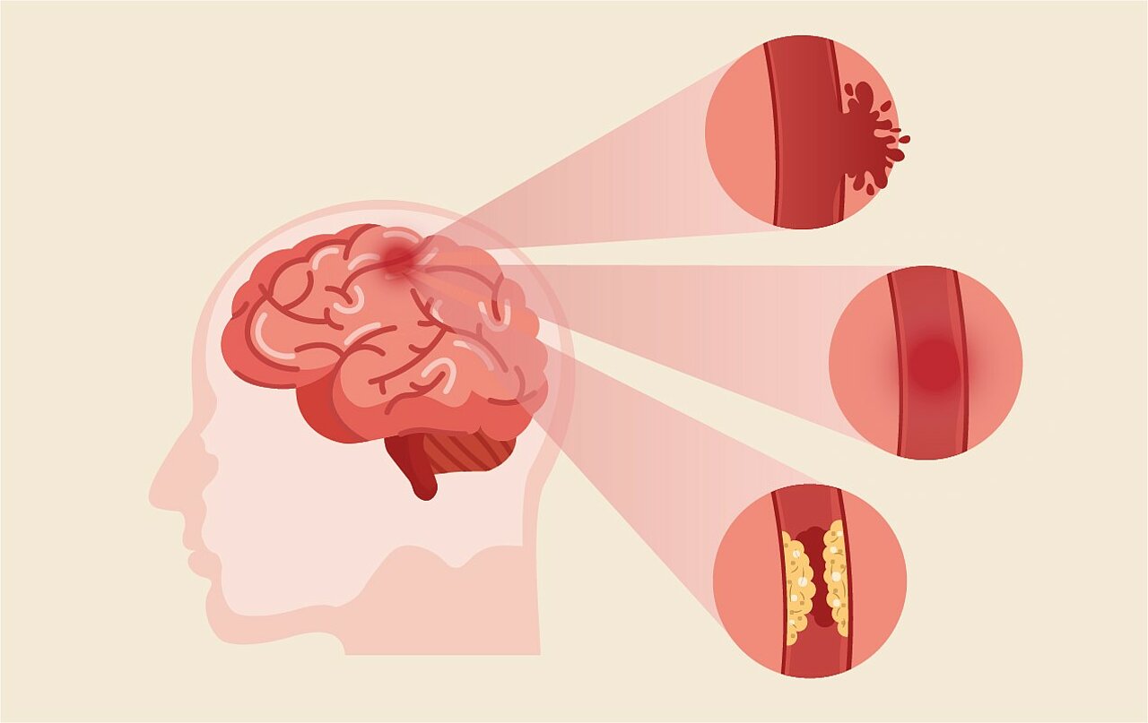 Infografik zur Veranschaulichung der unterschiedlichen Ursachen eines Schlaganfalls